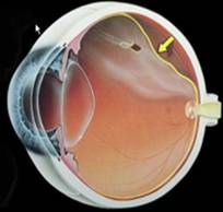 desprendimiento de vitreo agujero de retina